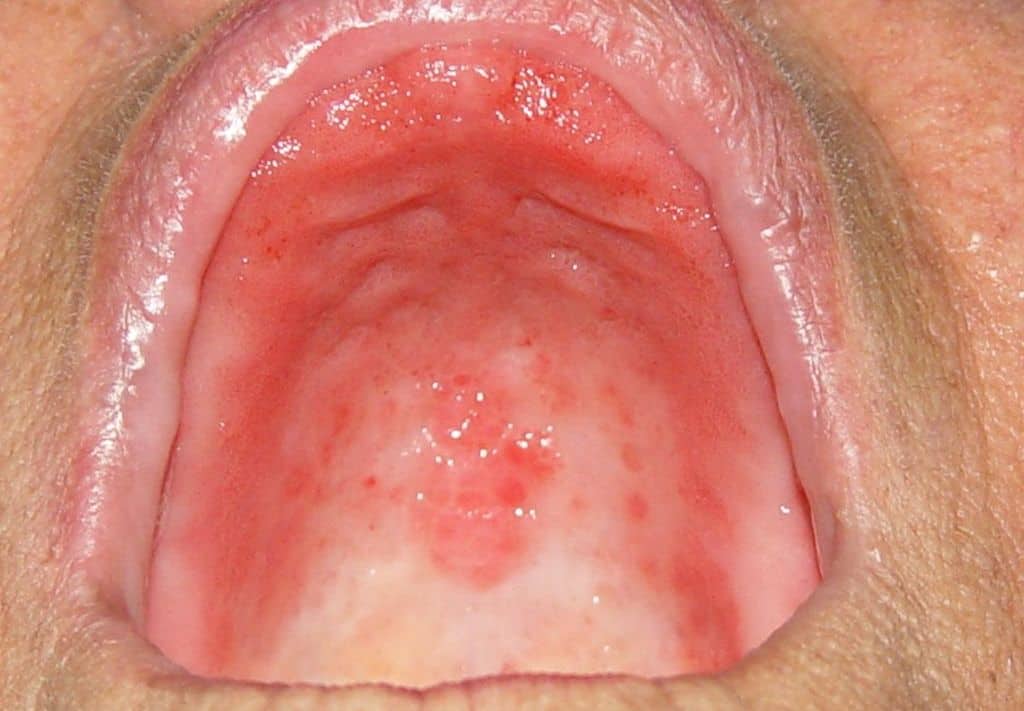 Candidiase Oral Do Diagnostico Ao Tratamento Local Odonto